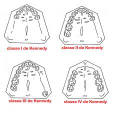 classes de Kennedy