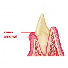 sous-gingival